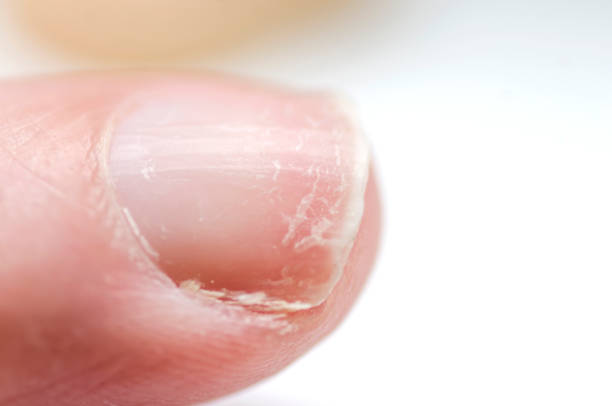 Should You Get a Manicure If You Have Nail Ridges? 4 Things to Know