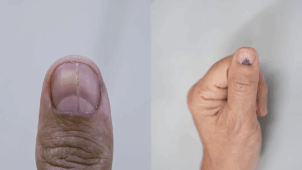 Móng tay bị sọc