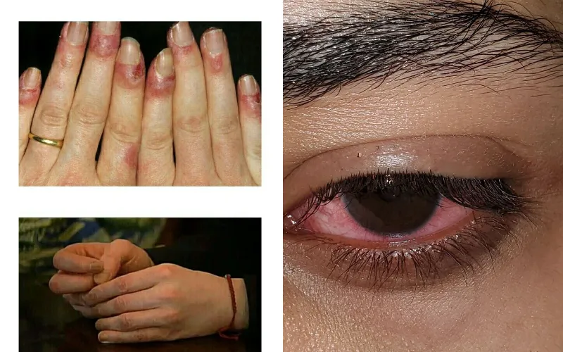 Acetone có thể gây đỏ mắt và rát da