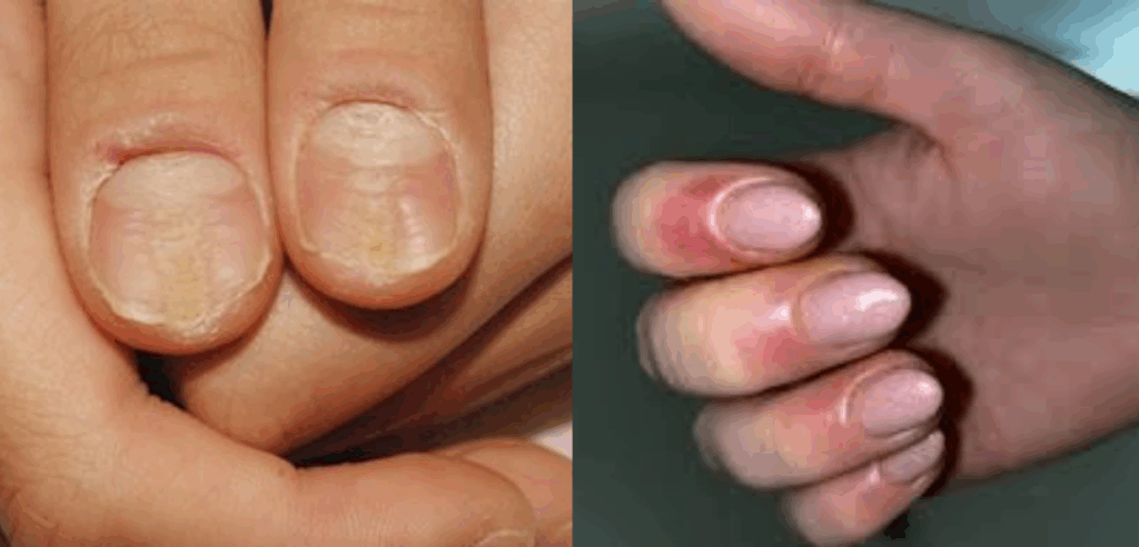 Potential consequences of using fake press-on nails