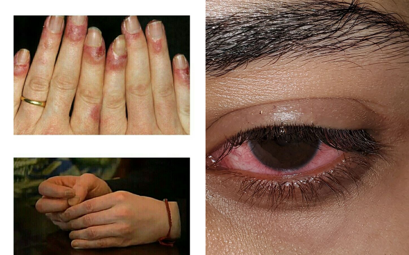 Acetone can irritate eyes and cause skin burning or redness