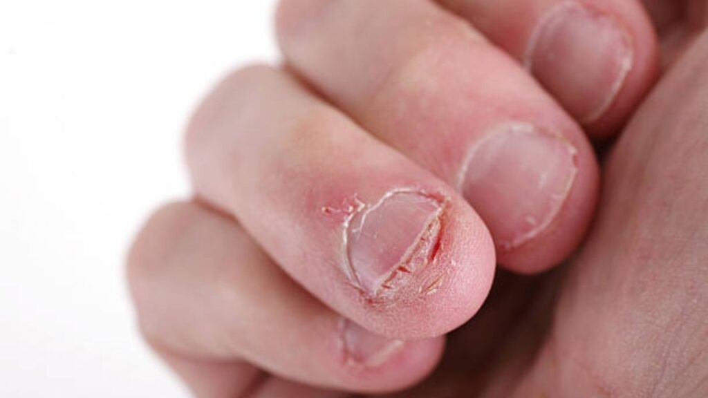 Nails and cuticles can be damaged by frequent nail biting