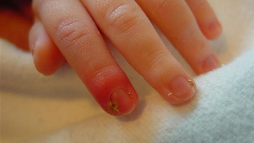 Paronychia (infection around the nail) can occur with frequent nail biting