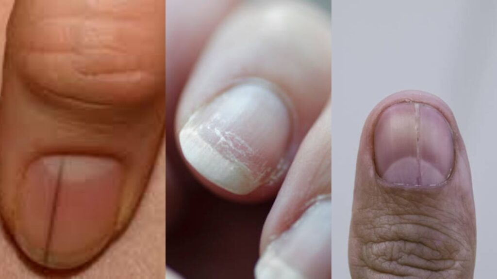 Common types of nail ridges