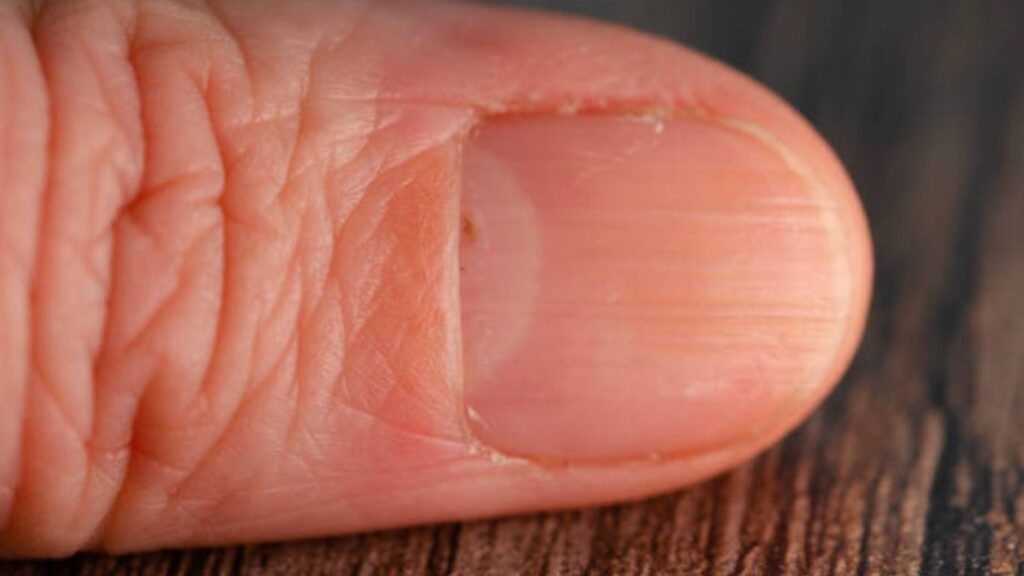 Vertical ridges on nails