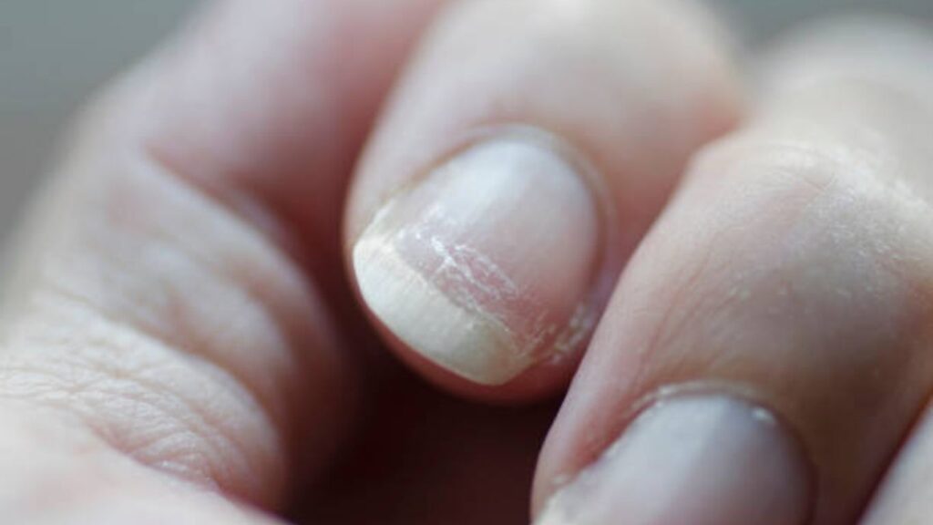 Horizontal ridges on nails