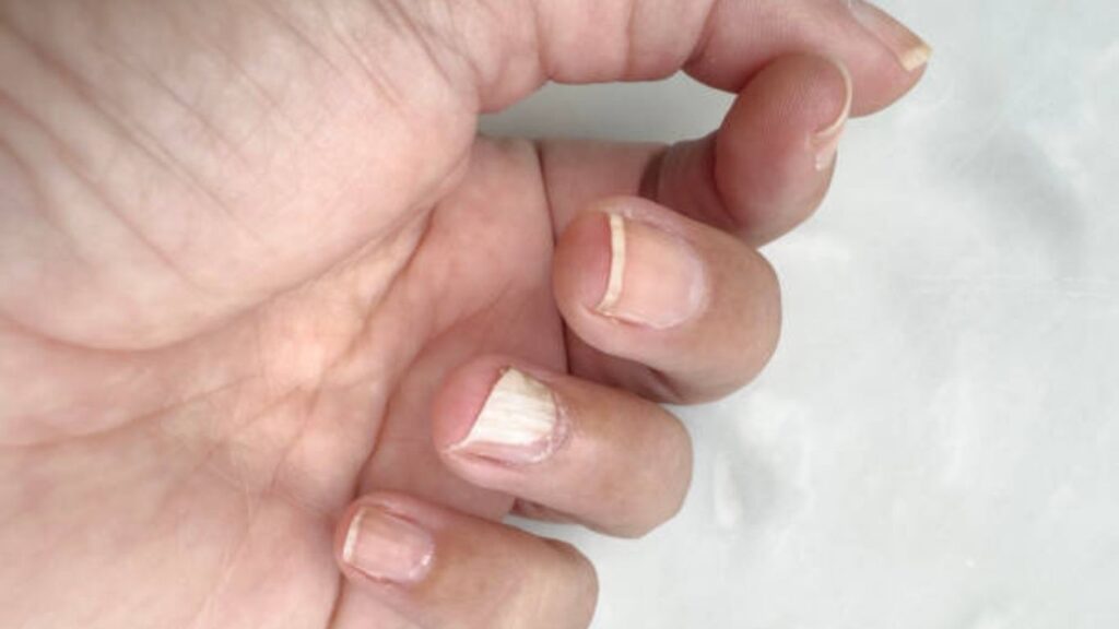 Broken nails after gel manicure damage